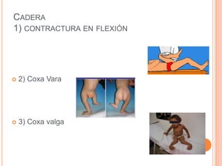 CADERA
1) CONTRACTURA EN FLEXIÓN
 2) Coxa Vara
 3) Coxa valga
 