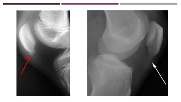 Duele el cuello se ha hinchado a la derecha