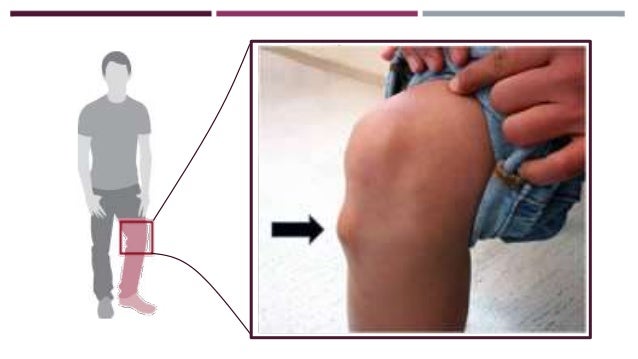 Las indicaciones al tratamiento a la escoliosis de la columna vertebral