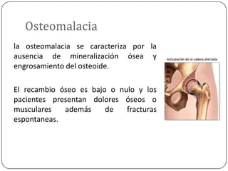 Osteomalacia
la osteomalacia se caracteriza por la
ausencia de mineralización ósea y
engrosamiento del osteoide.
El recambio óseo es bajo o nulo y los
pacientes presentan dolores óseos o
musculares
además
de
fracturas
espontaneas.

 