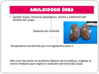 Amiloidosis ósea
 Quistes óseos, fracturas patológicas, artritis y síndromes del

túneles del carpo.

Deposito de amiloide

Paraproteina constituida por microglobulina beta 2.

Sitio mas frecuente en tendones flexores de la muñeca, engloba al
nervio mediano que origina el síndrome del túnel del carpo.

 