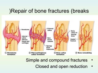 Repair of bone fractures (breaks(
•Simple and compound fractures
•Closed and open reduction
 