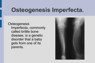 Osteogenesis Imperfecta.

Osteogenesis
 Imperfecta, commonly
 called brittle bone
 disease, is a genetic
 disorder that a baby
 gets from one of its
 parents.
 