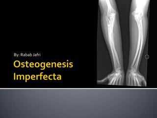 OsteogenesisImperfecta By: Rabab Jafri 