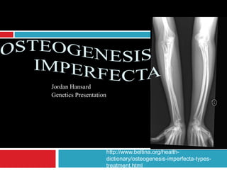 Jordan Hansard
Genetics Presentation
http://www.beltina.org/health-
dictionary/osteogenesis-imperfecta-types-
treatment.html
 