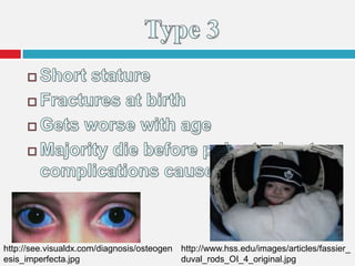 http://see.visualdx.com/diagnosis/osteogen
esis_imperfecta.jpg
http://www.hss.edu/images/articles/fassier_
duval_rods_OI_4_original.jpg
 