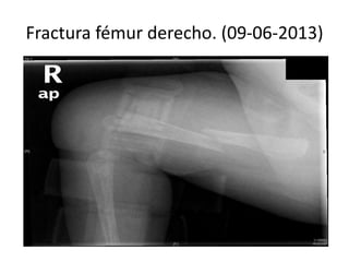 Fractura fémur derecho. (09-06-2013)

 