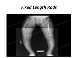 Fixed Length Rods 
 