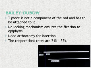 T piece is not a component of the rod and has to
be attached to it
 No locking mechanism ensures the fixation to
epiphysis
 Need arthrotomy for insertion
 The reoperations rates are 21% - 32%
 
