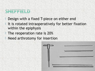  Design with a fixed T-piece on either end
 It is rotated intraoperatively for better fixation
within the epiphysis
 The reoperation rate is 20%
 Need arthrotomy for insertion
 