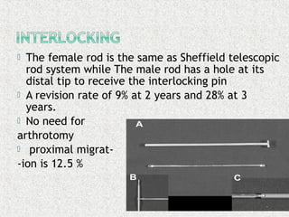 The female rod is the same as Sheffield telescopic
rod system while The male rod has a hole at its
distal tip to receive the interlocking pin
 A revision rate of 9% at 2 years and 28% at 3
years.
 No need for
arthrotomy
 proximal migrat-
-ion is 12.5 %
 