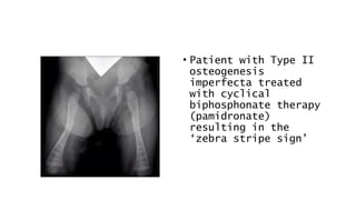 • Patient with Type II
osteogenesis
imperfecta treated
with cyclical
biphosphonate therapy
(pamidronate)
resulting in the
‘zebra stripe sign’
 