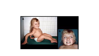 Osteogenesis Imperfecta presentation .pptx