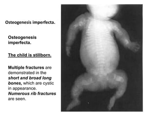 Osteogenesis imperfecta.
Osteogenesis
imperfecta.
The child is stillborn.
Multiple fractures are
demonstrated in the
short and broad long
bones, which are cystic
in appearance.
Numerous rib fractures
are seen.
 