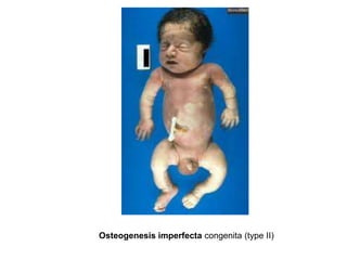 Osteogenesis imperfecta congenita (type II)
 
