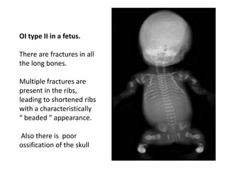 OI type II in a fetus.
There are fractures in all
the long bones.
Multiple fractures are
present in the ribs,
leading to shortened ribs
with a characteristically
“ beaded ” appearance.
Also there is poor
ossification of the skull
 