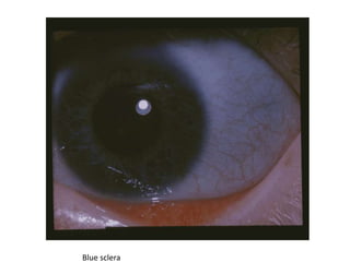 Blue sclera
 