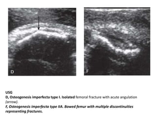 USG
D, Osteogenesis imperfecta type I. Isolated femoral fracture with acute angulation
(arrow).
F, Osteogenesis imperfecta type IIA. Bowed femur with multiple discontinuities
representing fractures.
 