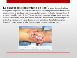La osteogénesis imperfecta de tipo V es un tipo moderado de
osteogénesis imperfecta (OI; ver este término), un trastorno genético caracterizado por
un aumento de la fragilidad ósea, masa ósea baja y susceptibilidad a fracturas óseas de
gravedad variable. La OI de tipo V se caracteriza por estatura baja de leve a moderada,
luxación de la cabeza radial, membranas interóseas mineralizadas, callos hiperplásicos,
esclerótica blanca y no presenta dentinogénesis imperfecta Hasta la fecha, se han
descrito 47 casos aun no se sabe si es recesiva o causante exacto de este .
 