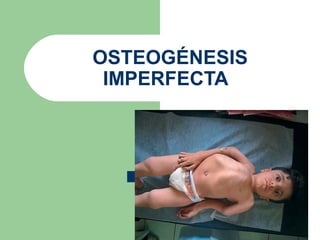  OSTEOGÉNESIS
IMPERFECTA
 