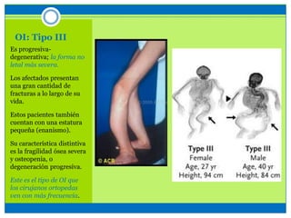 OI: Tipo III
Es progresiva-
degenerativa; la forma no
letal más severa.
Los afectados presentan
una gran cantidad de
fracturas a lo largo de su
vida.
Estos pacientes también
cuentan con una estatura
pequeña (enanismo).
Su característica distintiva
es la fragilidad ósea severa
y osteopenia, o
degeneración progresiva.
Este es el tipo de OI que
los cirujanos ortopedas
ven con más frecuencia.
 