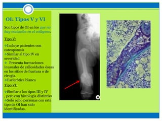 OI: Tipos V y VI
Son tipos de OI en los que no
hay mutación en el colágeno.
Tipo V:
Incluye pacientes con
osteoporosis
Similar al tipo IV en
severidad
 Presenta formaciones
inusuales de callosidades óseas
en los sitios de fractura o de
cirugía.
Esclerótica blanca
Tipo VI:
Similar a los tipos III y IV
, pero con histología distintiva
Sólo ocho personas con este
tipo de OI han sido
identificadas.
 