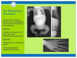 OI: Mutaciones
Recesivas
Los tipos VII y VIII son
formas recien identificadas
de OI que son heredadas de
forma recesiva.
Tipo VII:
Similar a los tipos II y IV
pero tiene como
característica la rhizomelia.
Tipo VIII:
Deficiencia de crecimiento
severa
Submineralización
extrema de los huesos.
 