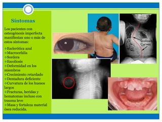 Síntomas
Los pacientes con
osteogénesis imperfecta
manifiestan uno o más de
estos síntomas:
Esclerótica azul
Macrocefalia
Sordera
Escoliosis
Deformidad en los
miembros
Crecimiento retardado
Dentadura deficiente
Curvatura de los huesos
largos
Fracturas, heridas y
hematomas incluso con
trauma leve
Masa y fortaleza material
ósea reducida.
 