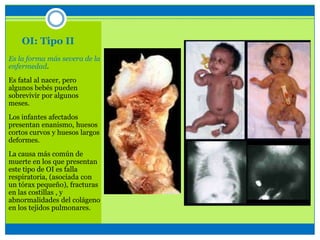 OI: Tipo II
Es la forma más severa de la
enfermedad.
Es fatal al nacer, pero
algunos bebés pueden
sobrevivir por algunos
meses.
Los infantes afectados
presentan enanismo, huesos
cortos curvos y huesos largos
deformes.
La causa más común de
muerte en los que presentan
este tipo de OI es falla
respiratoria, (asociada con
un tórax pequeño), fracturas
en las costillas , y
abnormalidades del colágeno
en los tejidos pulmonares.
 