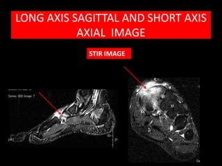 LONG AXIS SAGITTAL AND SHORT AXIS
           AXIAL IMAGE
            STIR IMAGE
 