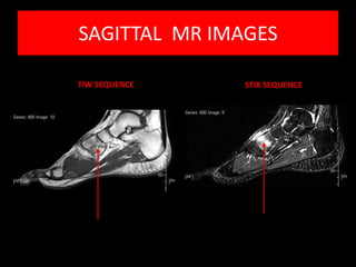 SAGITTAL MR IMAGES

TIW SEQUENCE   STIR SEQUENCE
 