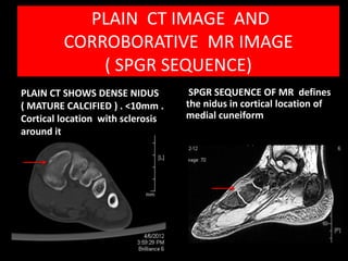 PLAIN CT IMAGE AND
         CORROBORATIVE MR IMAGE
             ( SPGR SEQUENCE)
PLAIN CT SHOWS DENSE NIDUS          SPGR SEQUENCE OF MR defines
( MATURE CALCIFIED ) . <10mm .     the nidus in cortical location of
Cortical location with sclerosis   medial cuneiform
around it
 
