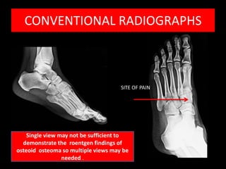 CONVENTIONAL RADIOGRAPHS



                                     SITE OF PAIN




    Single view may not be sufficient to
  demonstrate the roentgen findings of
osteoid osteoma so multiple views may be
                 needed .
 