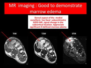 MR imaging : Good to demonstrate
        marrow edema
               Dorsal aspect of the medial
         cuneiform has focal subcentimetre
             SIZED MR signal change in the
            subcortical location. Appreciate
         significant ill defined marrow edema

 TIW                T2W                         STIR
 