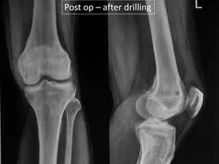 Post op – after drilling

 