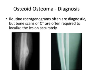 Osteoid Osteoma - Diagnosis
• Routine roentgenograms often are diagnostic,
but bone scans or CT are often required to
localize the lesion accurately.

 