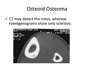 Osteoid Osteoma
• CT may detect the nidus, whereas
roentgenograms show only sclerosis.

 