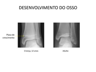 DESENVOLVIMENTO DO OSSO




    Placa de
crescimento




                 Criança, 12 anos   Adulto
 