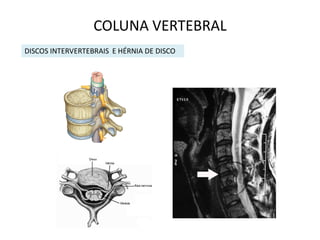 COLUNA VERTEBRAL
DISCOS INTERVERTEBRAIS E HÉRNIA DE DISCO
 