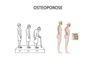 OSTEOPOROSE
 