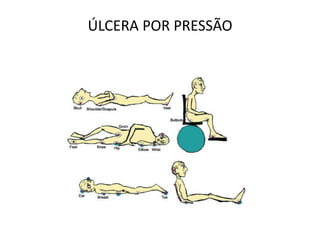 ÚLCERA POR PRESSÃO
 