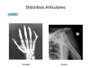 Distúrbios Articulares
LUXAÇÃO




          Falanges              Ombro
 
