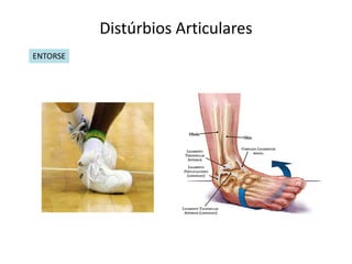Distúrbios Articulares
ENTORSE
 