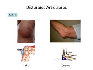 Distúrbios Articulares
BURSITE




          Joelho               Cotovelo
 