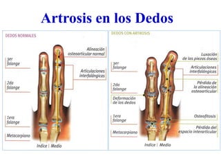 Artrosis en los Dedos
 