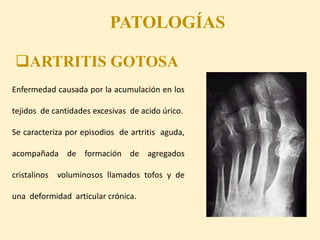 PATOLOGÍAS
ARTRITIS GOTOSA
Enfermedad causada por la acumulación en los
tejidos de cantidades excesivas de acido úrico.
Se caracteriza por episodios de artritis aguda,
acompañada de formación de agregados
cristalinos voluminosos llamados tofos y de
una deformidad articular crónica.
 
