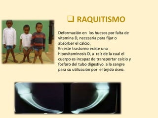 RAQUITISMO
Deformación en los huesos por falta de
vitamina D, necesaria para fijar o
absorber el calcio.
En este trastorno existe una
hipovitaminosis D, a raíz de la cual el
cuerpo es incapaz de transportar calcio y
fosforo del tubo digestivo a la sangre
para su utilización por el tejido óseo.
 