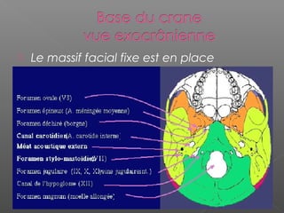  Le massif facial fixe est en place
 