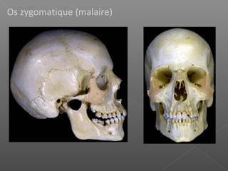 Os zygomatique (malaire)
F F
T
T
 