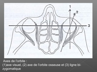 Axes de l’orbite :
(1)axe visuel, (2) axe de l’orbite osseuse et (3) ligne bi-
zygomatique
 